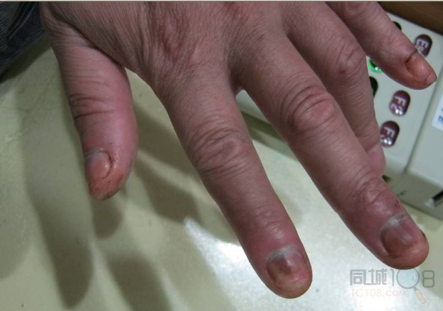 康甲堂灰指甲